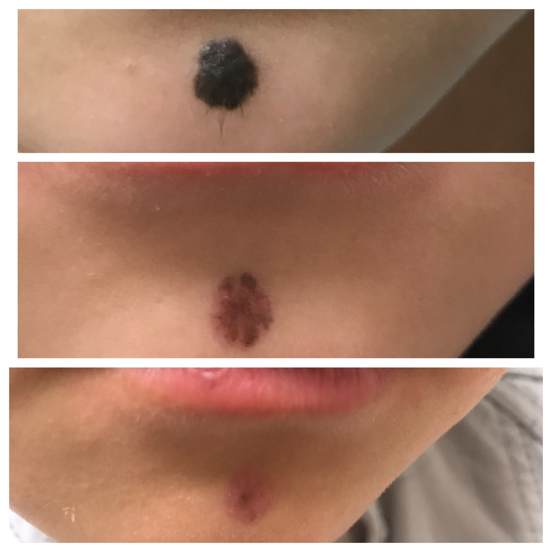 Questions For/About Mole Removal