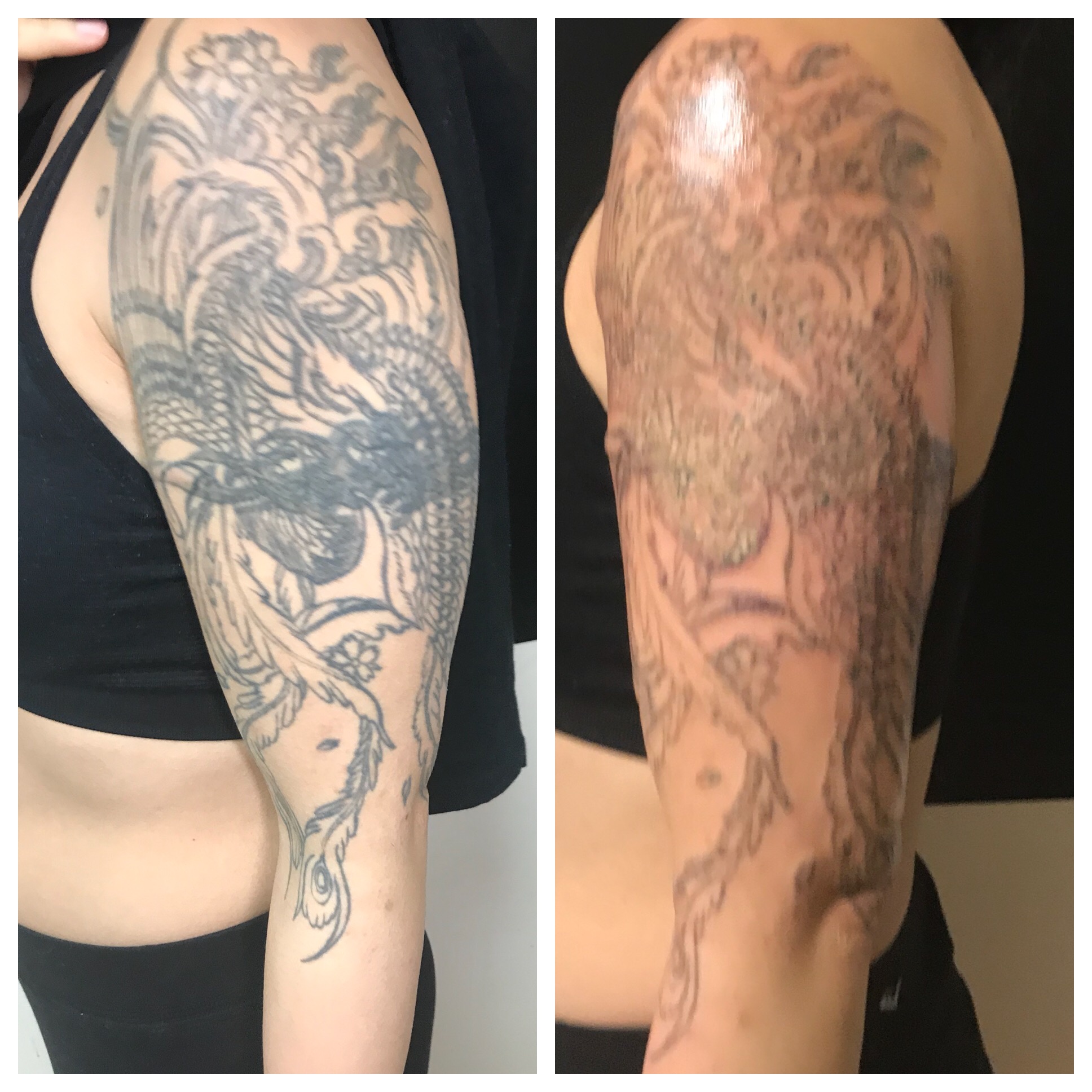 Laser Tattoo Removal Before and After