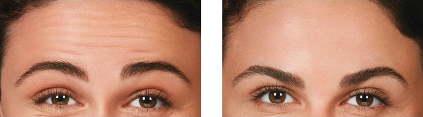Botox Forehead Lines Before and After