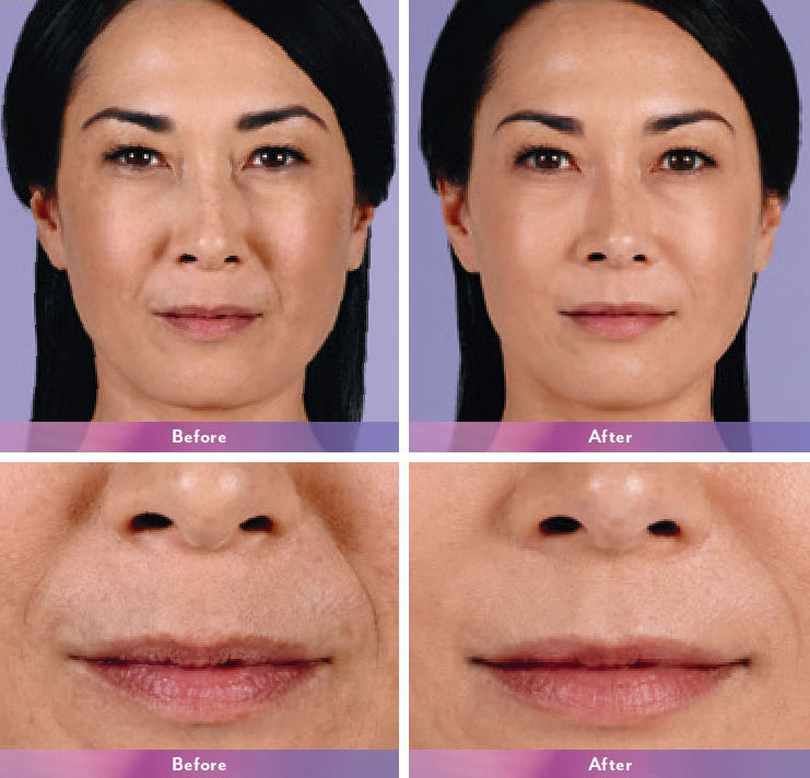 Juvederm Before and After