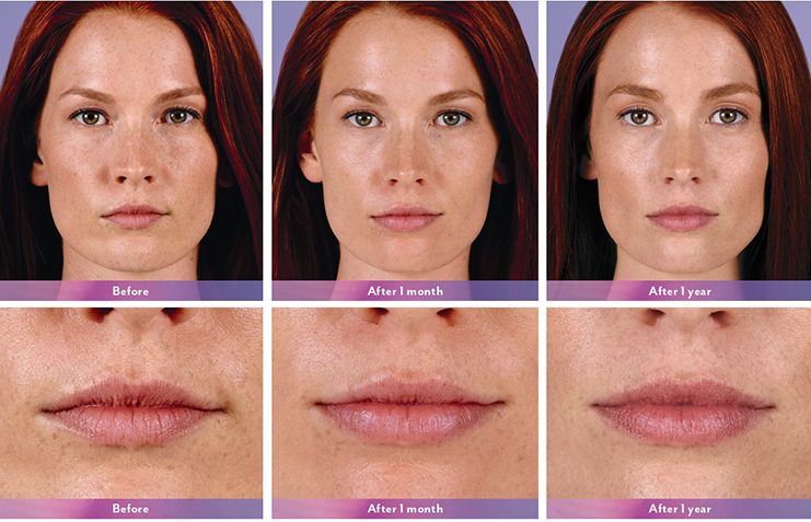 Juvederm Ultra XC Before and After